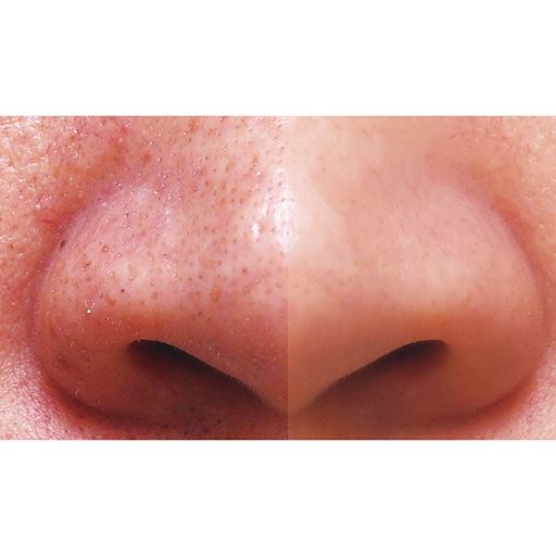 左:汚い鼻のイメージ<br>右:キレイな鼻のイメージ
