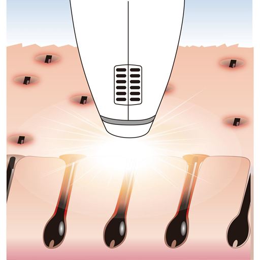 1)キセノンフラッシュでムダ毛ケア<br>キセノンフラッシュの光は黒色や濃い色に反応して熱を発生する性質があり、ムダ毛に熱を加えてダメージを与えます。また、美肌ケアも行えます。※イメージ