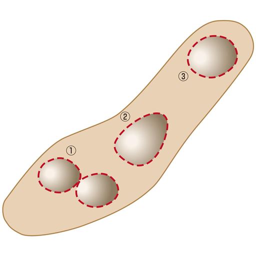 3つのパットが優しくフィット。<br>(1)つま先を安定 (2)土踏まずを支え、足の負担を軽減 (3)かかとへの衝撃を和らげる ※イメージ