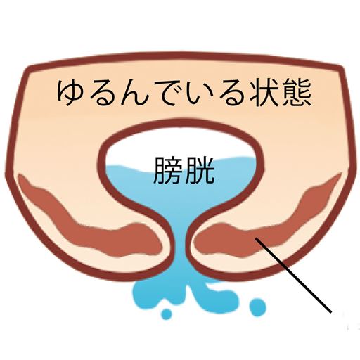 こんなお悩み、ありませんか!?<br> (1)ウォーキングやジムなどでの運動時に(2)せきやくしゃみの腹圧で「あっ!」(3)重い荷物を持ち上げた拍子に「ドキッ」