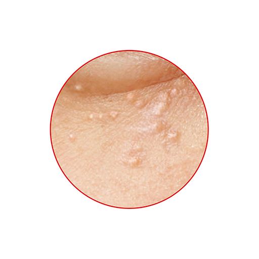 気になるポツポツ(※A)<br>※イメージ<br>※A 古い角質の固まり