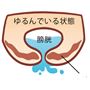 ※イメージ図 (1)骨盤底筋 ゆるんでいる状態 膀胱