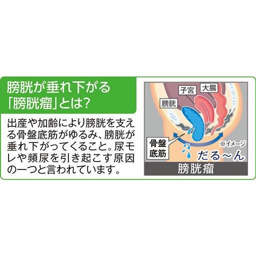 膀胱が垂れ下がる「膀胱瘤」とは?