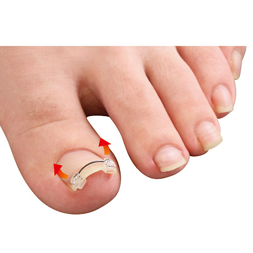 形状記憶合金ワイヤーの反発力が巻き爪を引き上げてクセづけます。<br>※イメージ