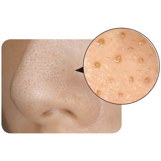 こんな毛穴の黒ずみ(※A)に<br><br>※A汚れや古い角質による