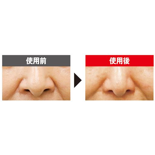 EMS(※1)で引き締まった美鼻を目指す<br>※メーカー調べ。 結果には個人差があり、効果を保証するものではありません。※モニター4名中1名のデータ。