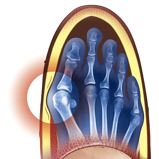 厚手クッション材が靴の圧迫によるズキッを和らげます。<br>※イメージ