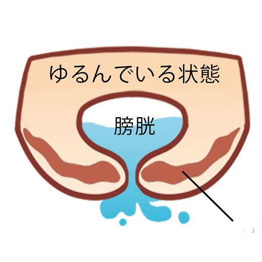 こんなお悩み、ありませんか!? (1)ウォーキングやジムなどでの運動時に(2)せきやくしゃみの腹圧で「あっ!」(3)重い荷物を持ち上げた拍子に「ドキッ」(4)骨盤底筋 ゆるんでいる状態 膀胱