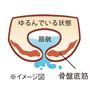 しっかり持ち上げることでお悩みや不安を軽減!骨盤底筋まわりがゆるんでいる状態