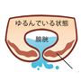 こんなお悩み、ありませんか!? (1)ウォーキングやジムなどでの運動時に(2)せきやくしゃみの腹圧で「あっ!」(3)重い荷物を持ち上げた拍子に「ドキッ」(4)骨盤底筋 ゆるんでいる状態 膀胱