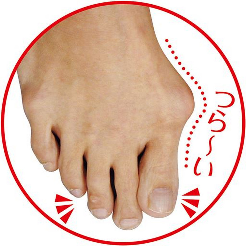 外反母趾になったらつらい
